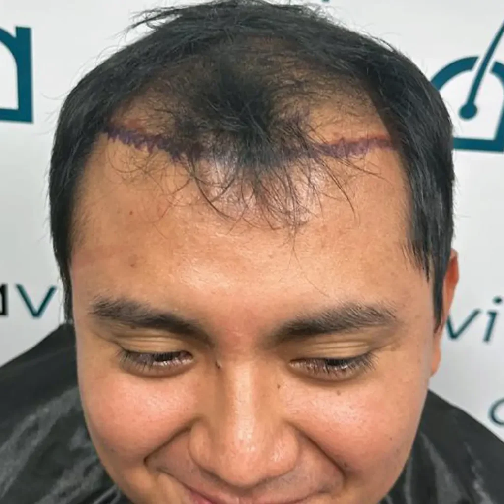 Antes